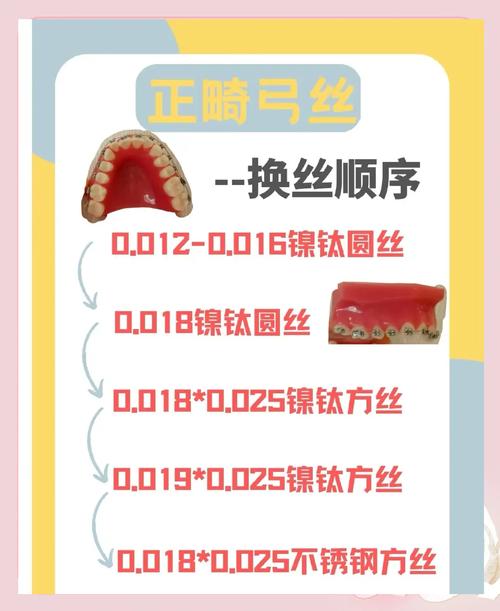 正畸 防止弓丝串位-图1 正畸 防止弓丝串位-图1