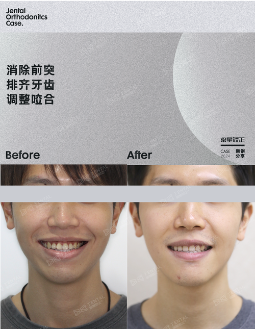 牙前凸适合怎么正畸-图3