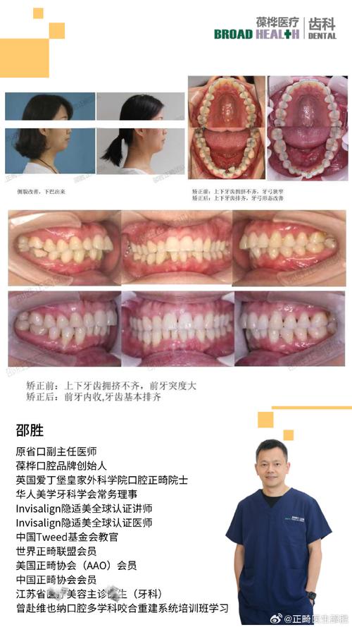 牙前凸适合怎么正畸-图2