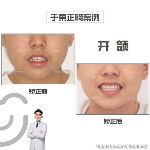 开颌正畸后容易复发吗?如何有效降低复发风险?-图1 开颌正畸后容易复发吗?如何有效降低复发风险?-图1