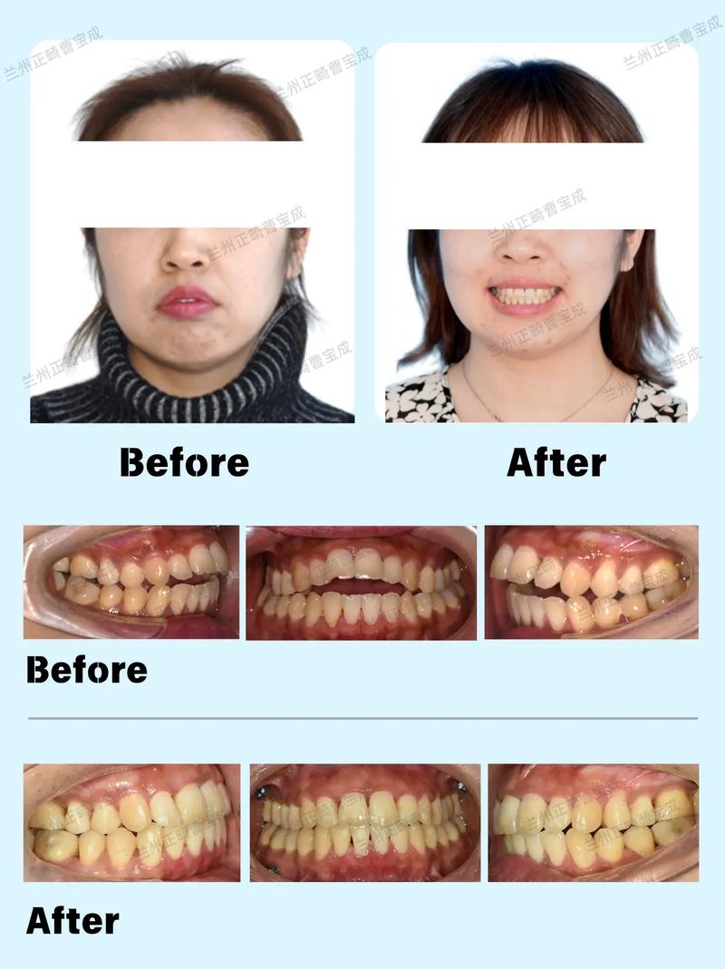 开颌正畸后容易复发吗?如何有效降低复发风险?-图3 开颌正畸后容易复发吗?如何有效降低复发风险?-图3