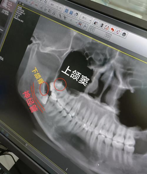 正畸上智齿近中漂移-图1