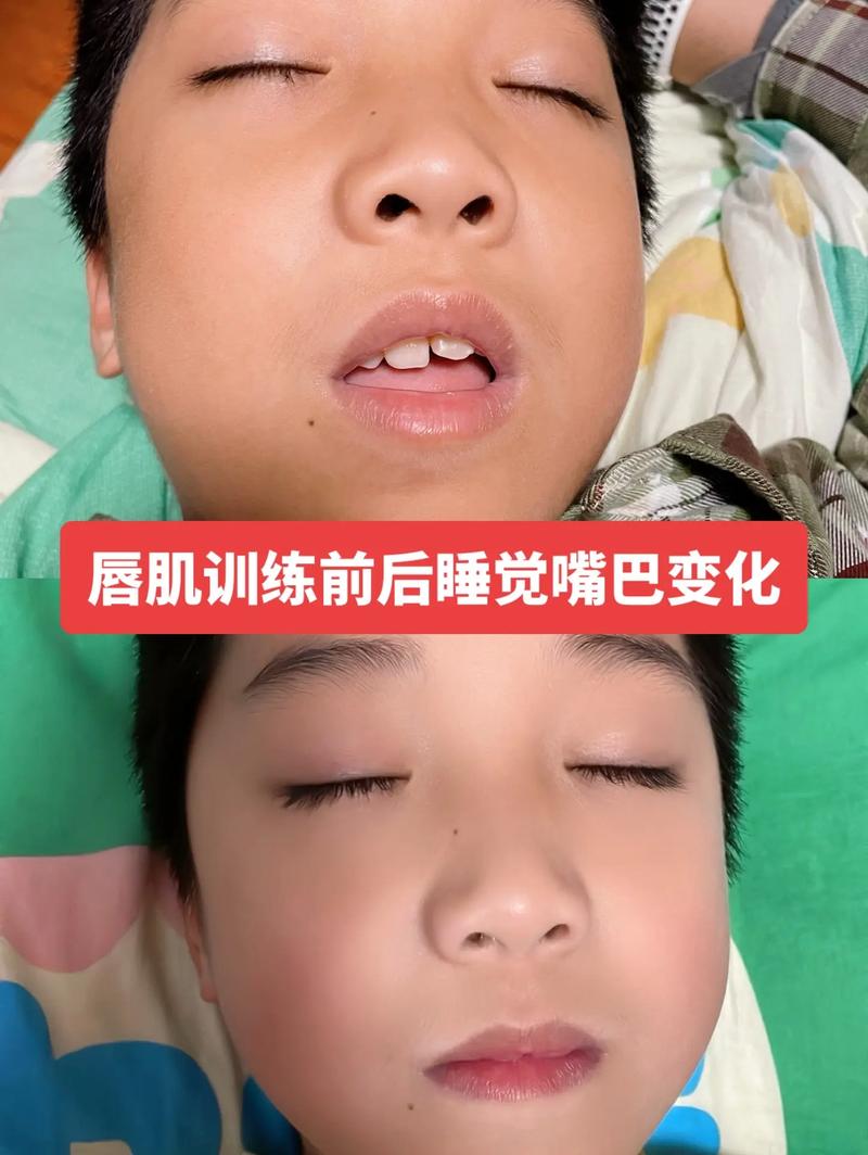 正畸医生让锻炼唇肌-图3