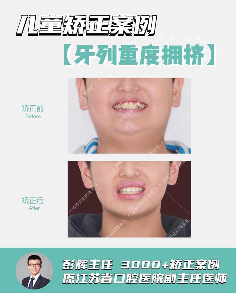 正畸牙齿拥挤的分类方法有哪些？-图2