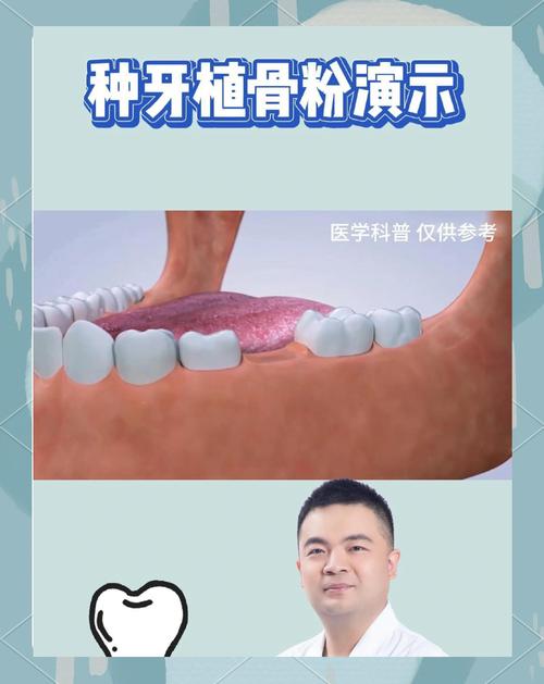 种牙需要骨粉吗-图1