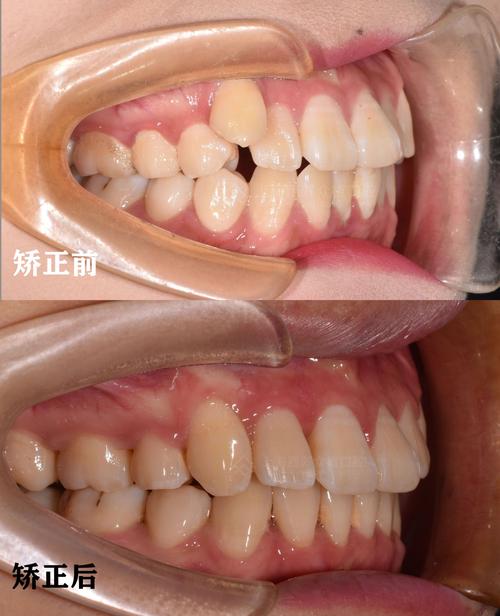 正畸期间后牙齿开合-图2