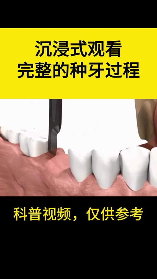 种牙全过程视频-图1