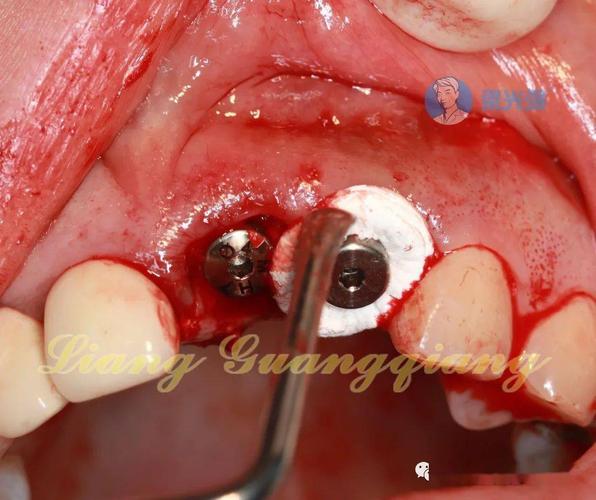 种牙全过程视频-图3
