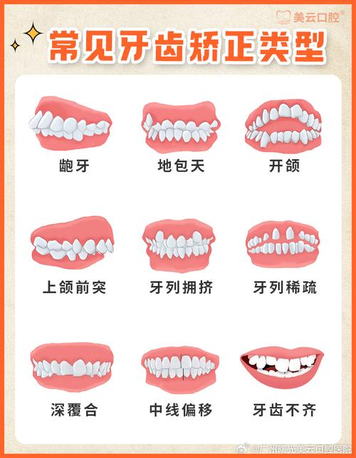 牙套有哪一种-图2