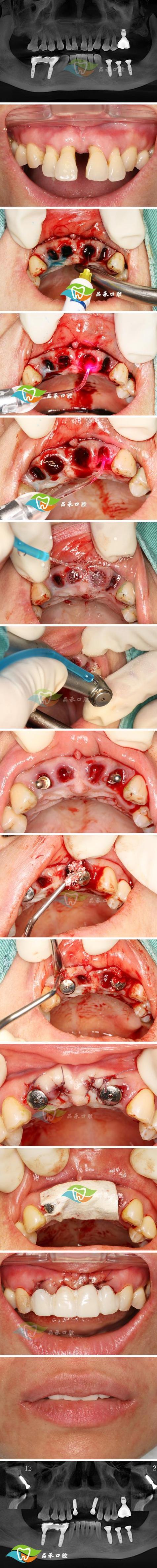 种一颗牙为何要花费上万元？费用构成合理吗？-图2
