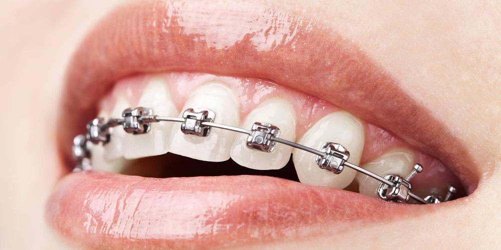 正畸活动牙套的图片-图3