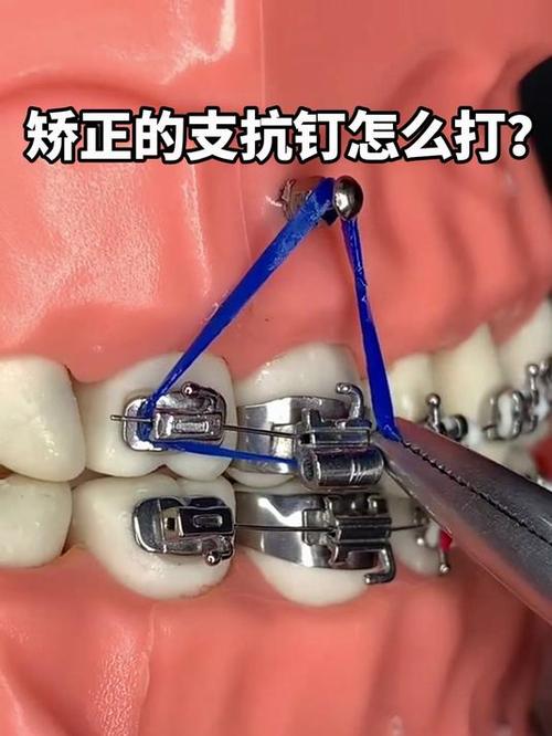 正畸支抗钉取钉疼吗？具体步骤和注意事项有哪些？-图2
