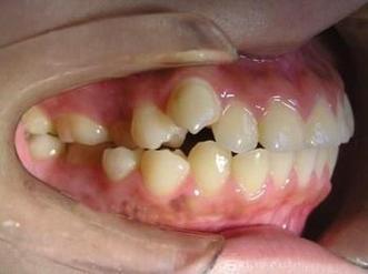 儿童青少年正畸拨牙-图2