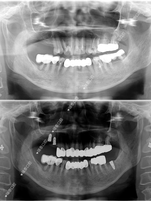 上颌5种植牙-图3