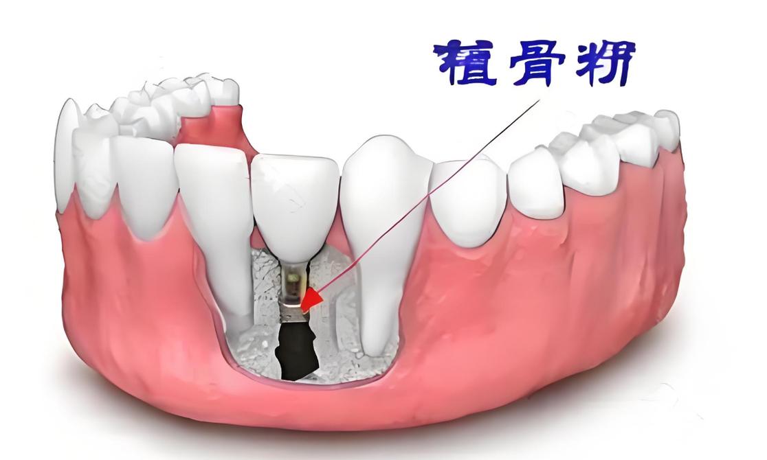 种牙扩骨疼吗-图1