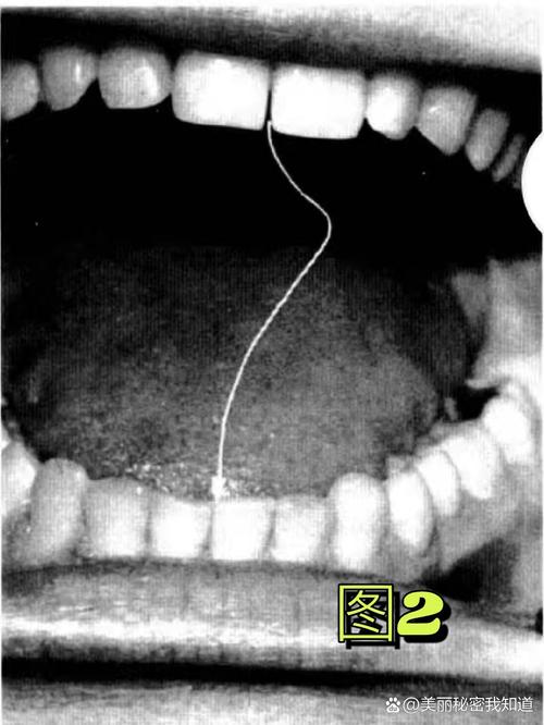 颞下颌关节弹响正畸-图1