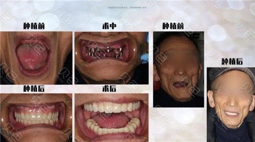 种牙纪中的好-图1