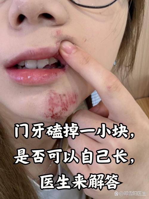 下切牙磕掉了想正畸-图2