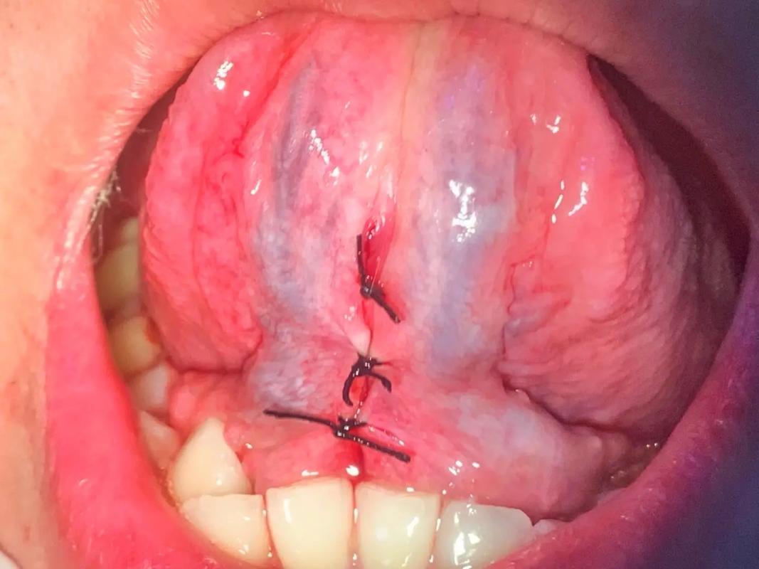 刚正畸后舌头不舒服-图2