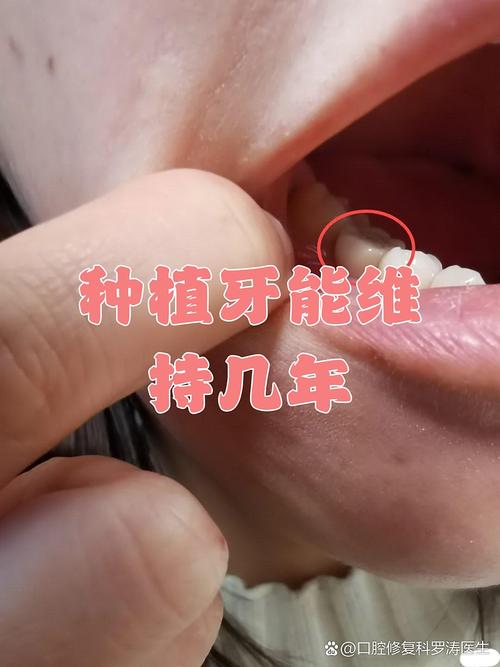 种牙还好坏吗-图3