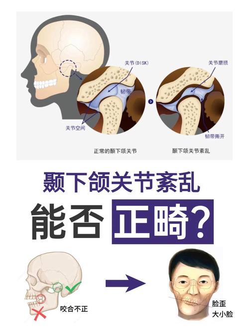 正畸期间 颌关节痛-图1 正畸期间 颌关节痛-图1