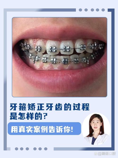 牙齿正畸=带牙套吗-图2