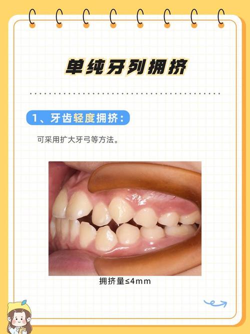牙列拥挤可以正畸吗-图1