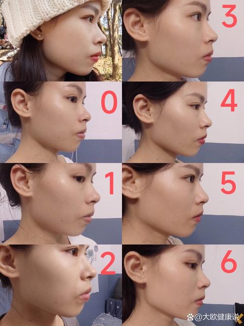 嘴突骨性正畸 日记-图1