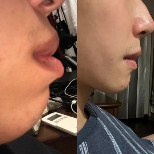 嘴突骨性正畸 日记-图2