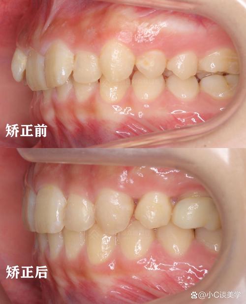 正畸过程中牙齿深覆合，该如何科学矫正？-图3