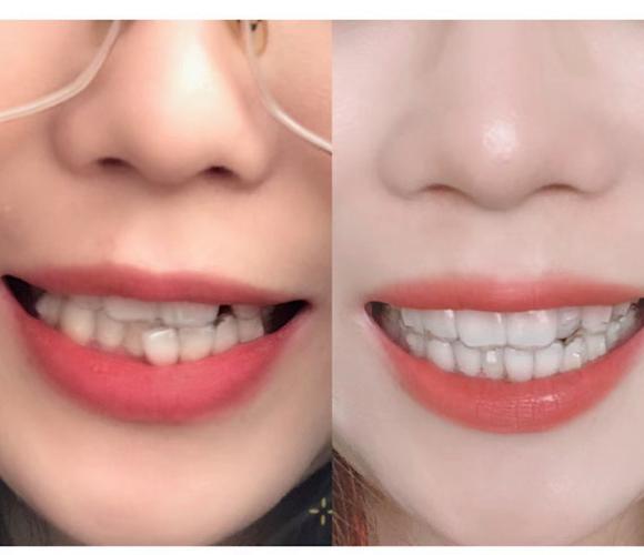 不正畸只戴隐形牙套-图1