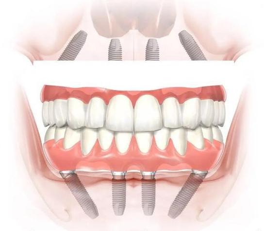 种牙后咬合力-图2