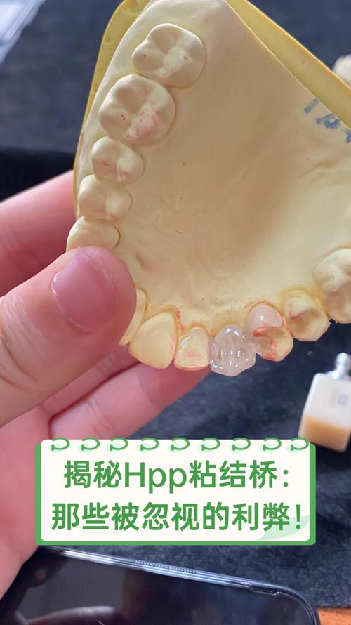 粘结桥和种牙-图2