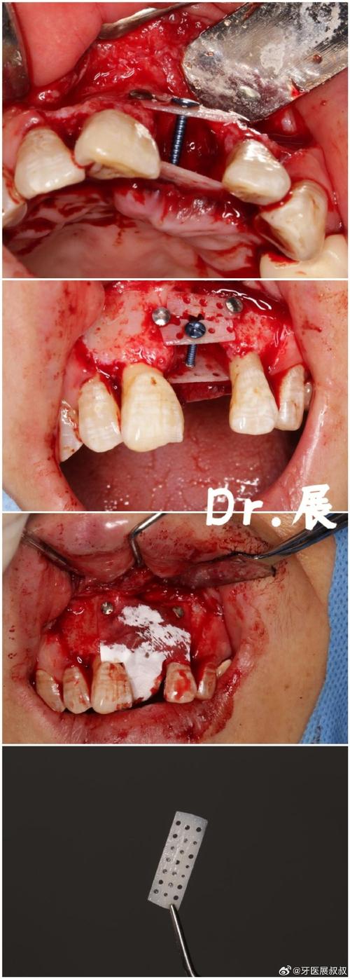 种牙植骨后发烧怎么回事？是正常现象还是需要担心？-图2