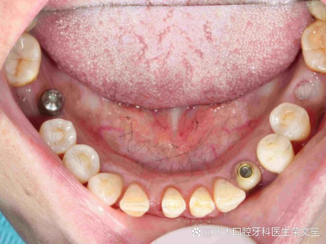 德国卡瓦种牙-图3 德国卡瓦种牙-图3