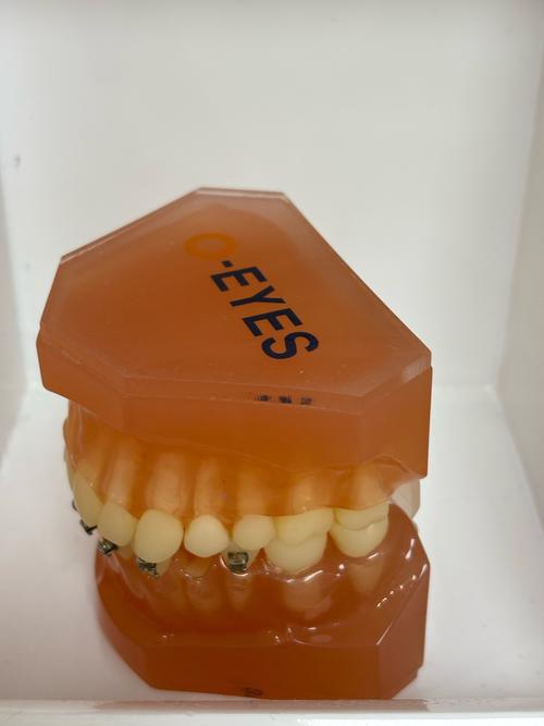 正畸粘接剂粘烤瓷牙-图1 正畸粘接剂粘烤瓷牙-图1