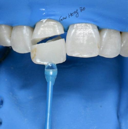 正畸粘接剂粘烤瓷牙-图3 正畸粘接剂粘烤瓷牙-图3