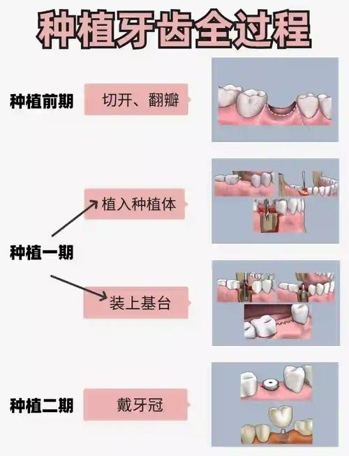 种义牙的条件-图3