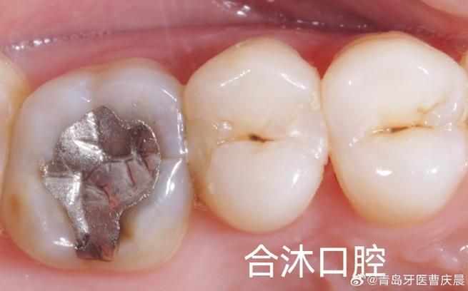 级差备洞种牙-图3