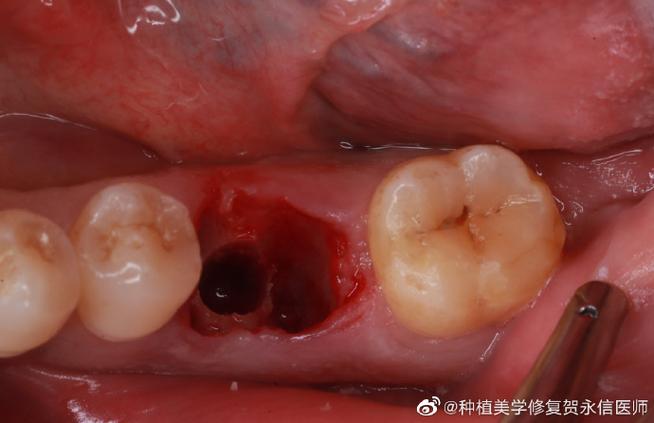 级差备洞种牙-图1
