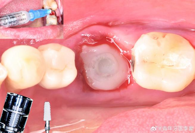 级差备洞种牙-图2