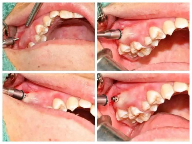 正畸都要打支抗钉吗-图3