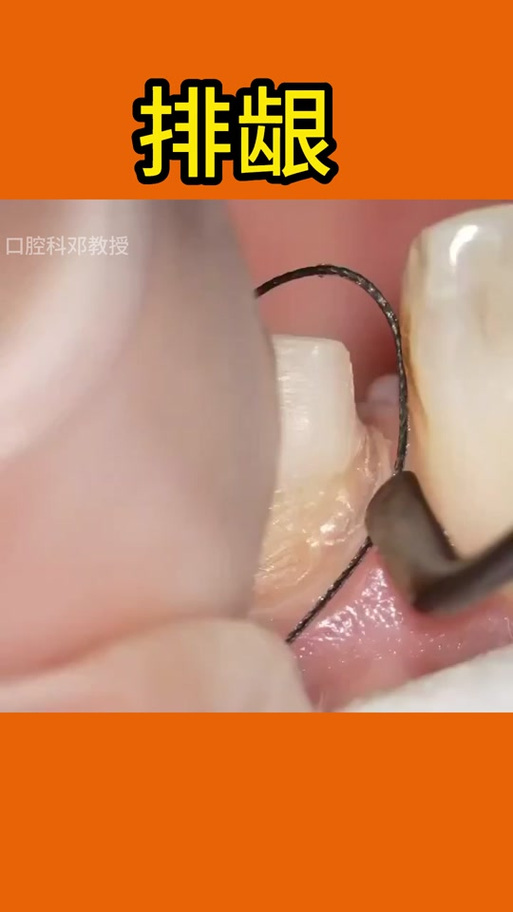 种牙为何需要排龈？这一步骤对种植效果和长期成功率有何关键影响？-图2