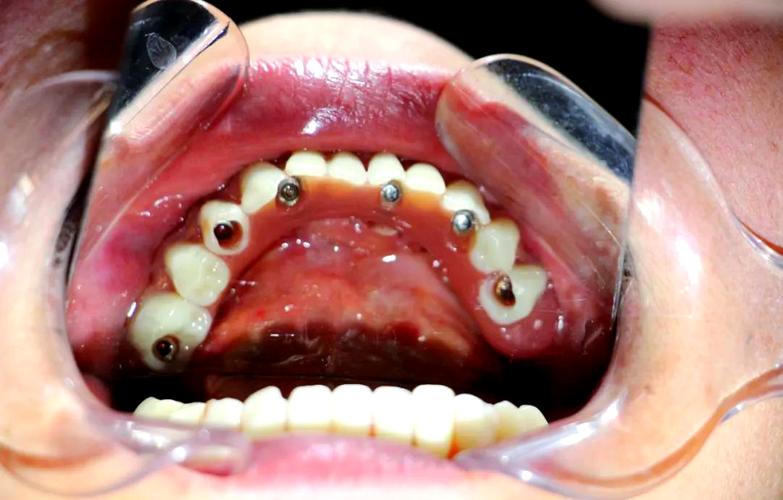 拔牙后即刻种植可行吗?效果与风险如何?-图1 拔牙后即刻种植可行吗?效果与风险如何?-图1