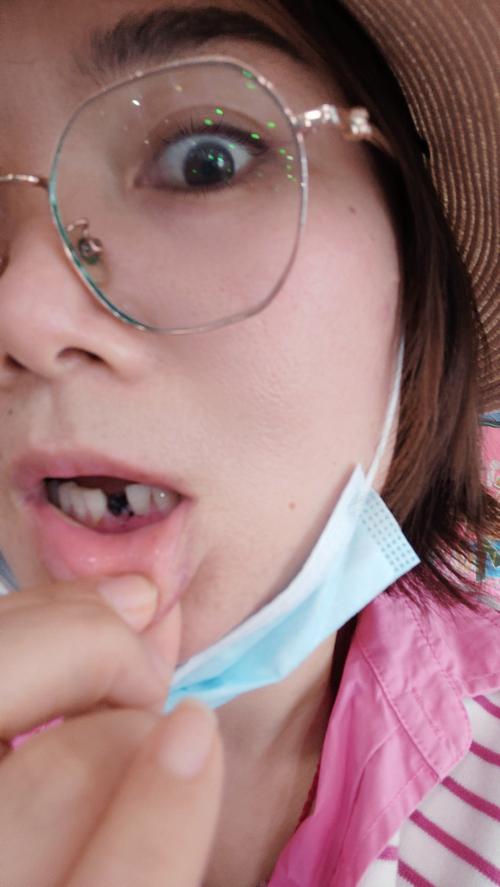 拔牙后即刻种植可行吗?效果与风险如何?-图2 拔牙后即刻种植可行吗?效果与风险如何?-图2