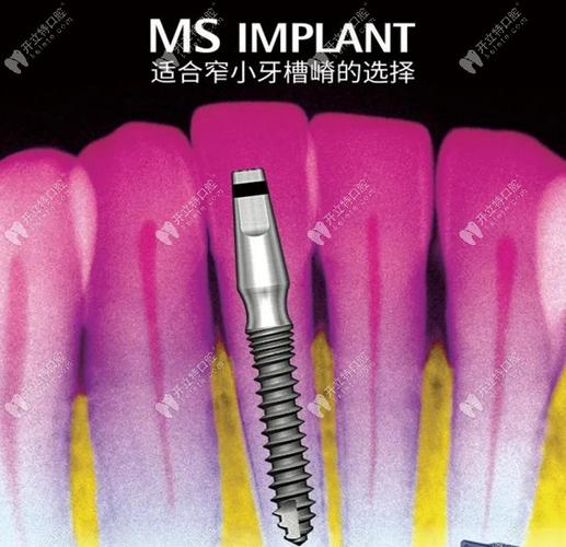 韩国种殖牙体-图2