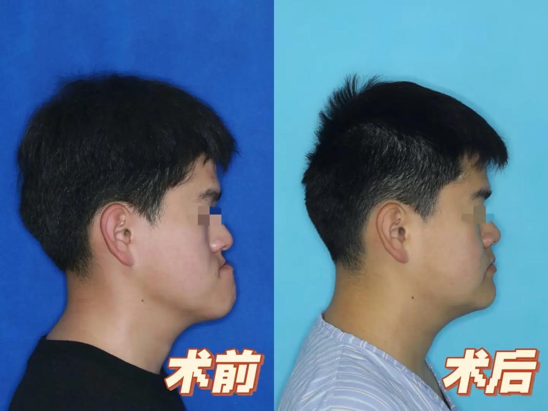 骨性地包天只做正畸，真的不用手术吗？-图2