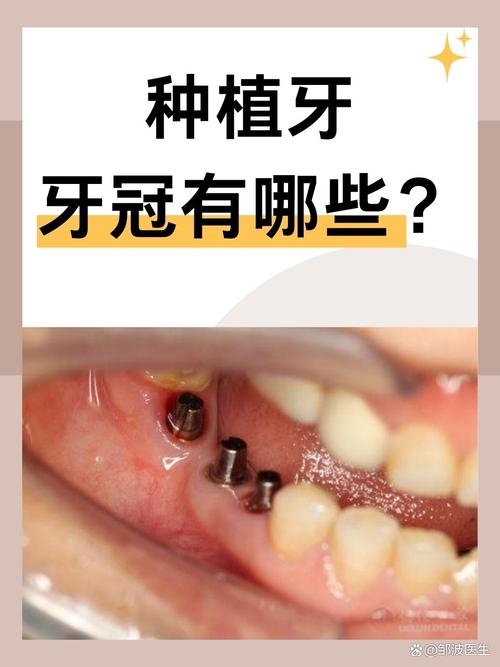种牙用哪种冠好?材质、价格、美观度如何权衡?-图1 种牙用哪种冠好?材质、价格、美观度如何权衡?-图1