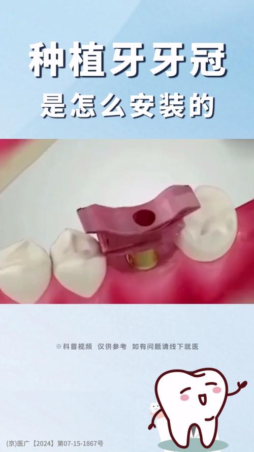 种牙用哪种冠好?材质、价格、美观度如何权衡?-图2 种牙用哪种冠好?材质、价格、美观度如何权衡?-图2