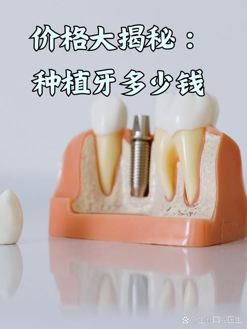 种牙钉贵还是-图1